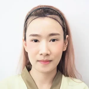 ก่อนปลูกผมผู้หญิง เกศา คลินิก | Female Hair Transplant Before - Kesa Hair Clinic
