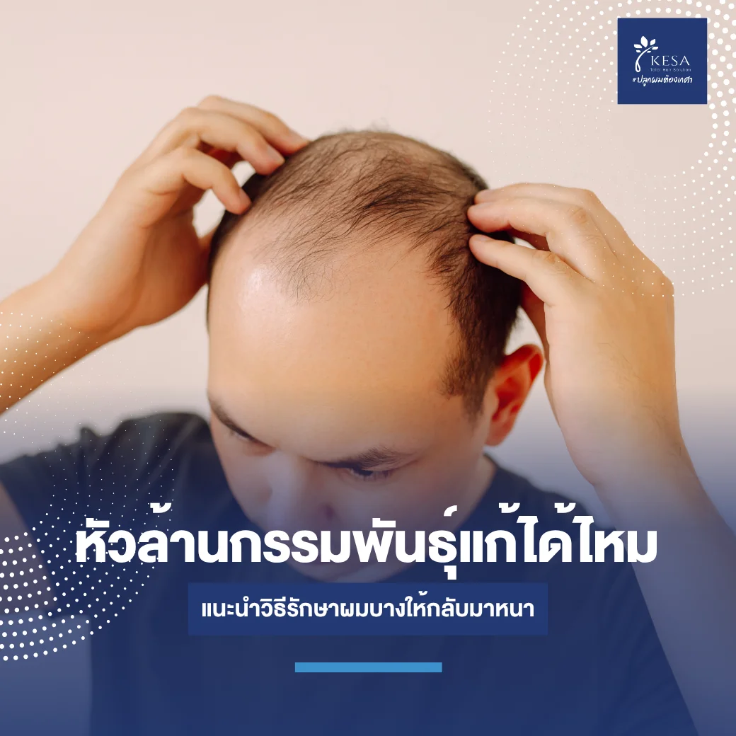 หัวล้านกรรมพันธุ์จากแก้ได้ไหม