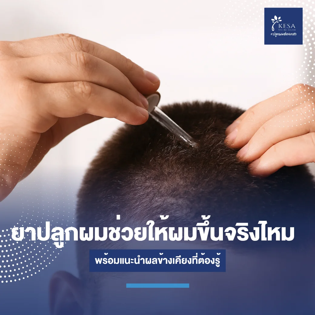 ยาปลูกผมช่วยให้ผมขึ้นจริงไหม