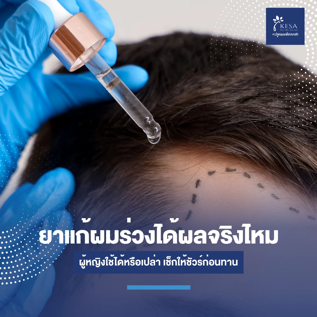 ยาแก้ผมร่วงได้ผลจริงไหม